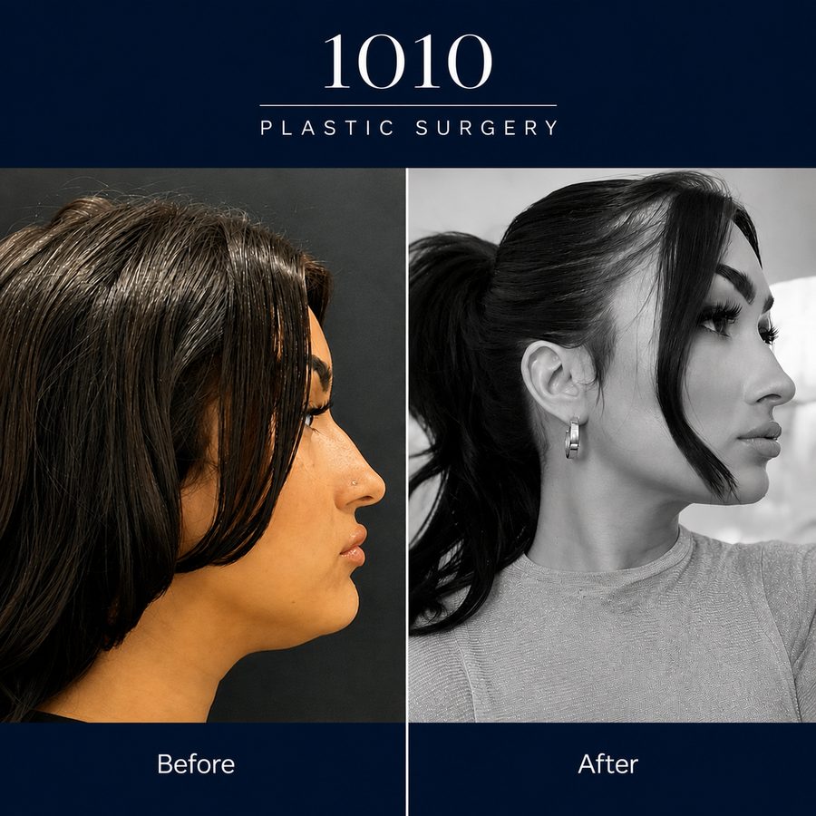 Chin liposuction before and after — 1010 Plastic Surgery