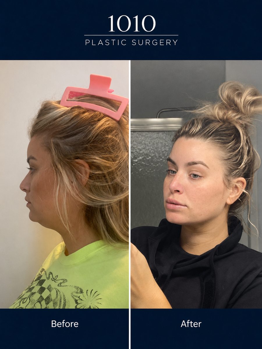 Chin liposuction before and after — 1010 Plastic Surgery