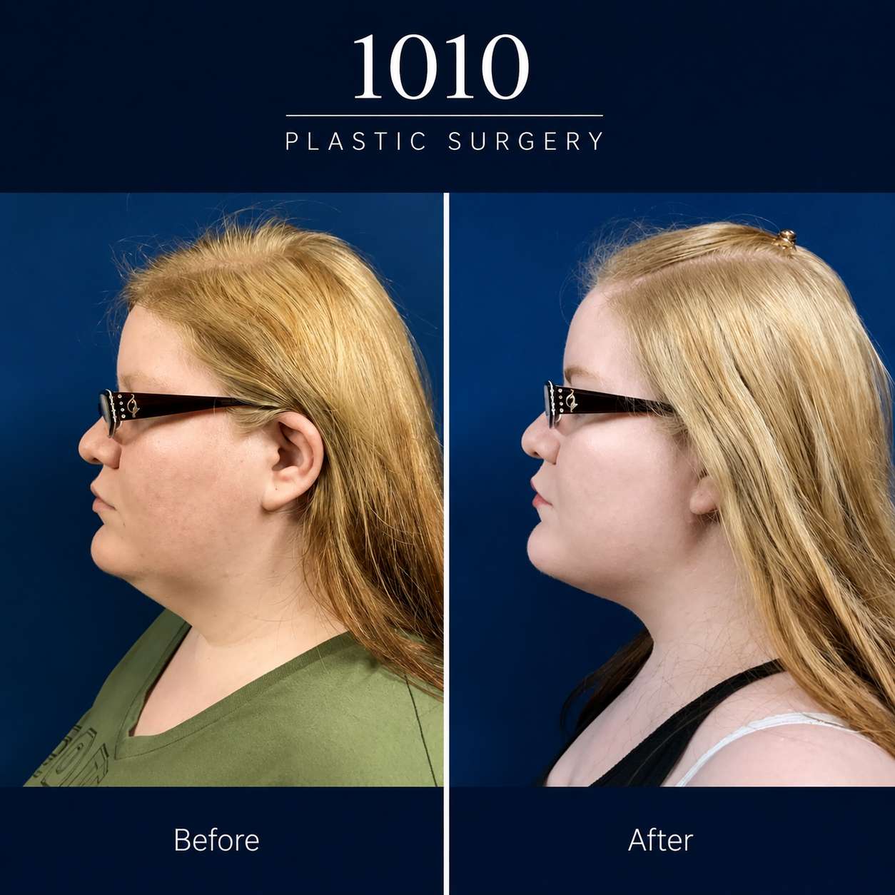 Chin liposuction before and after — 1010 Plastic Surgery