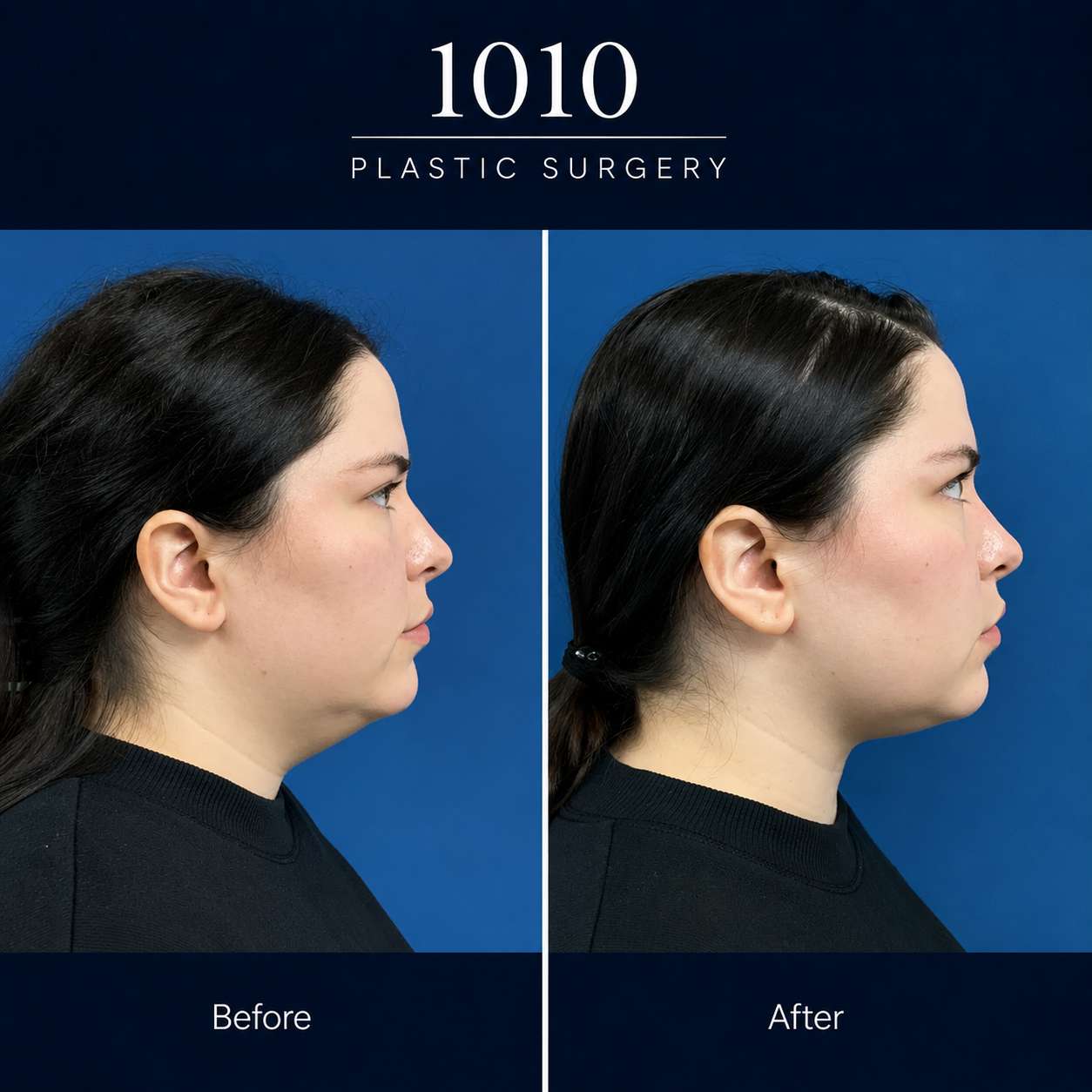 Chin liposuction before and after — 1010 Plastic Surgery