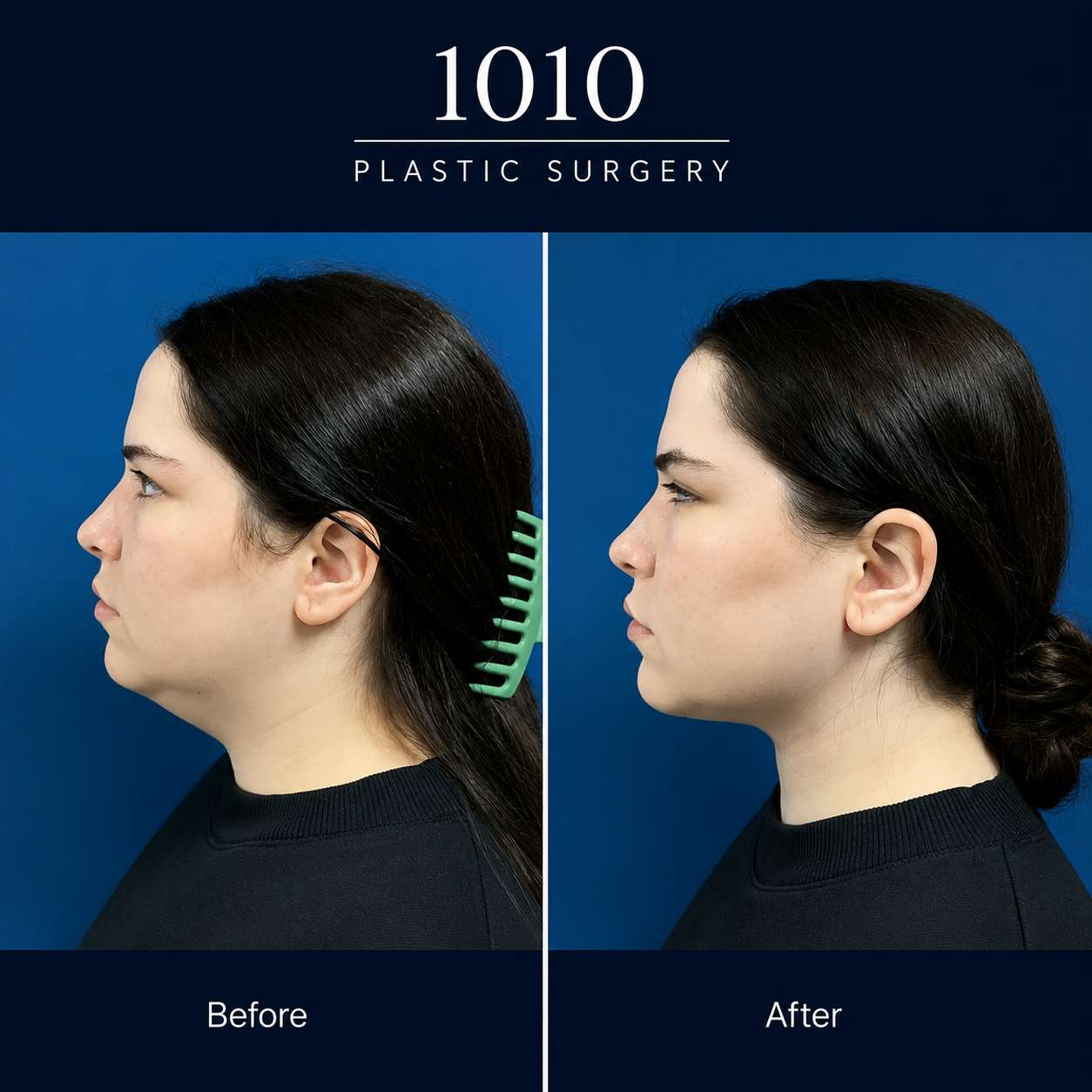 Chin liposuction before and after — 1010 Plastic Surgery
