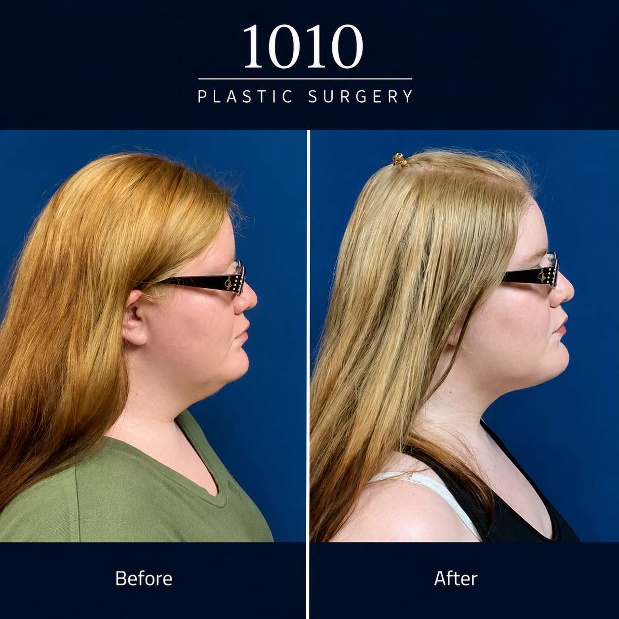 Chin liposuction before and after — 1010 Plastic Surgery