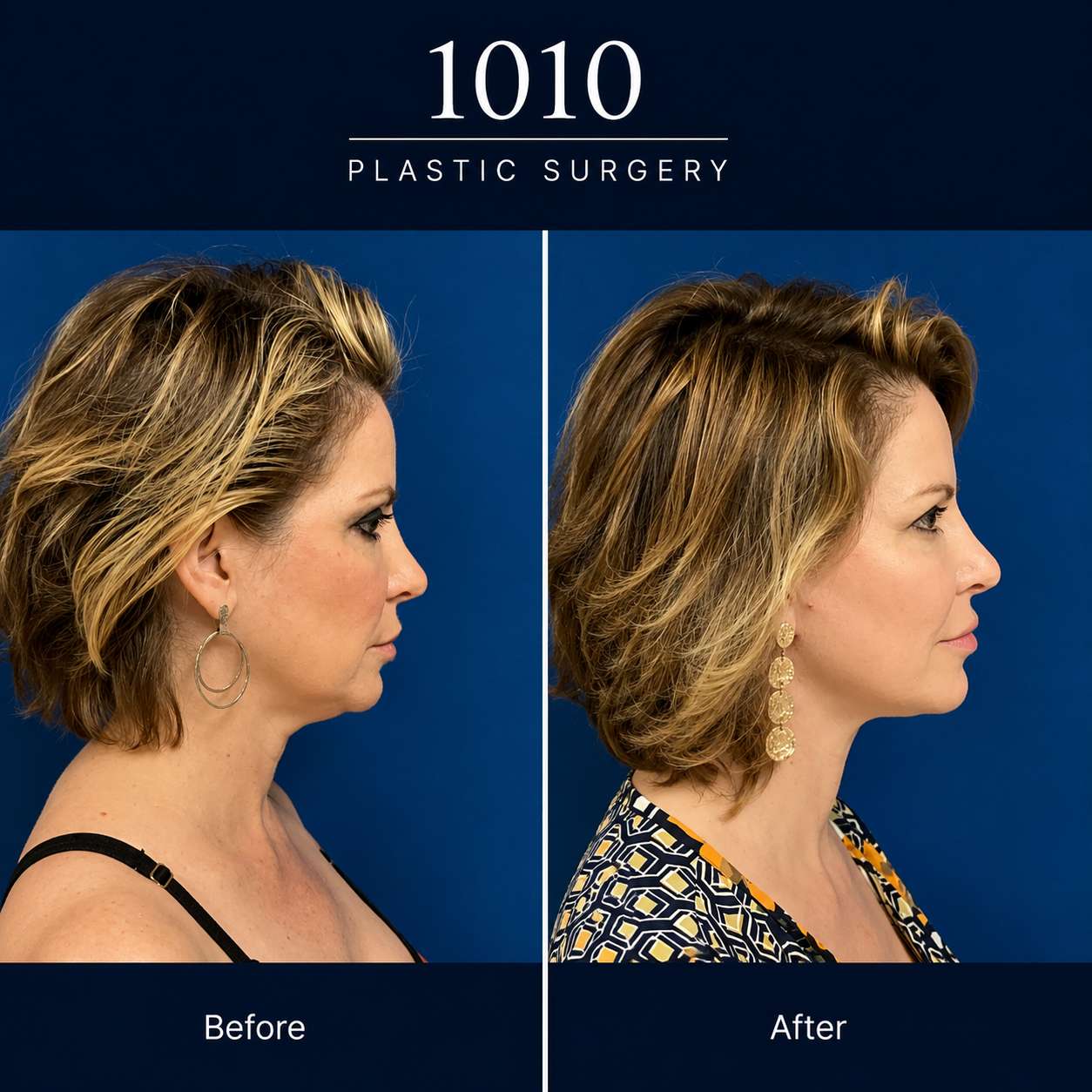 Chin liposuction before and after — 1010 Plastic Surgery