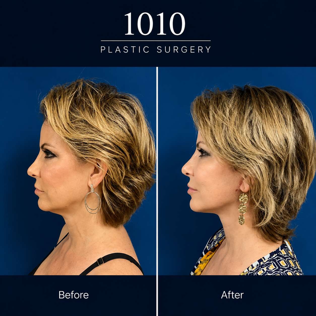 Chin liposuction before and after — 1010 Plastic Surgery