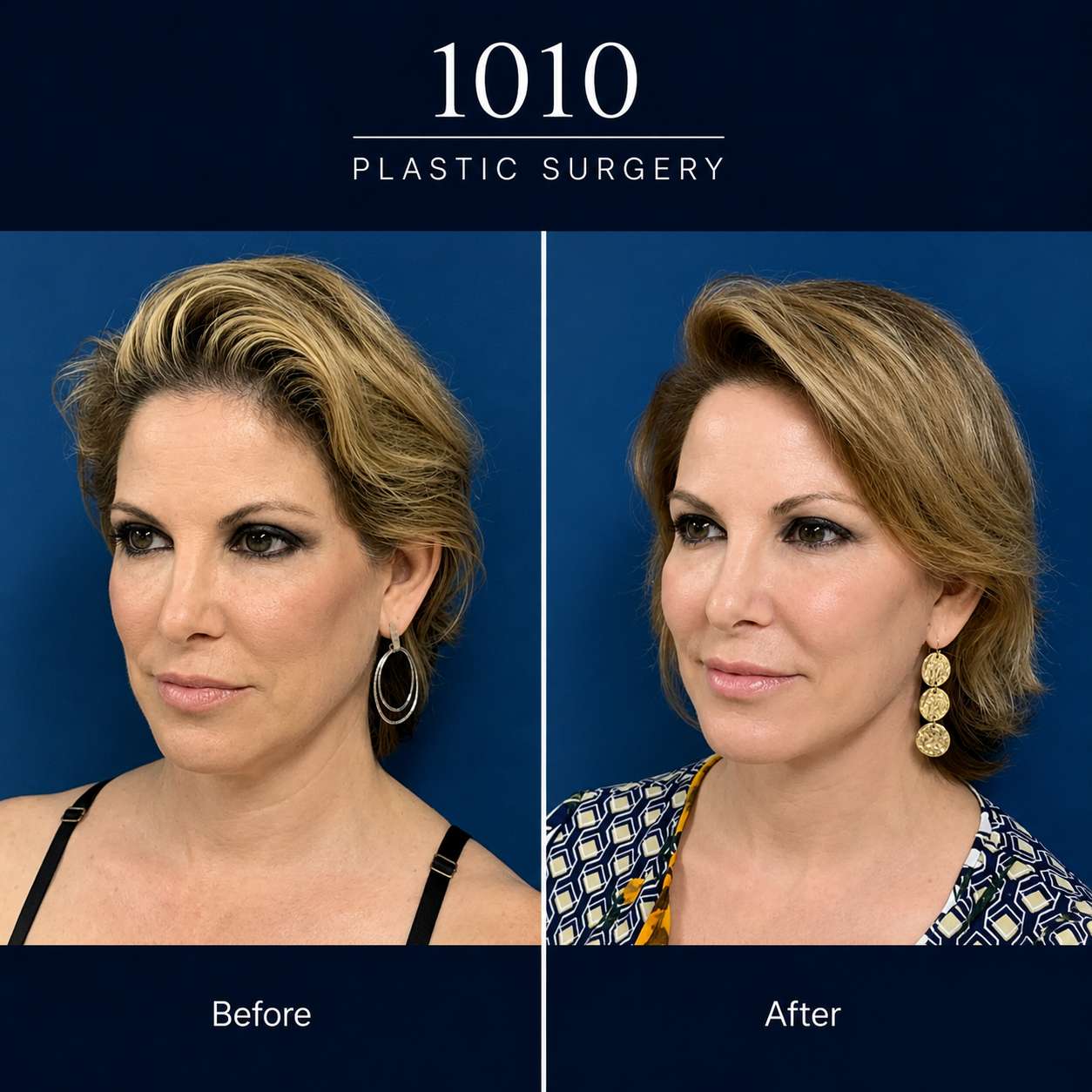 Chin liposuction before and after — 1010 Plastic Surgery