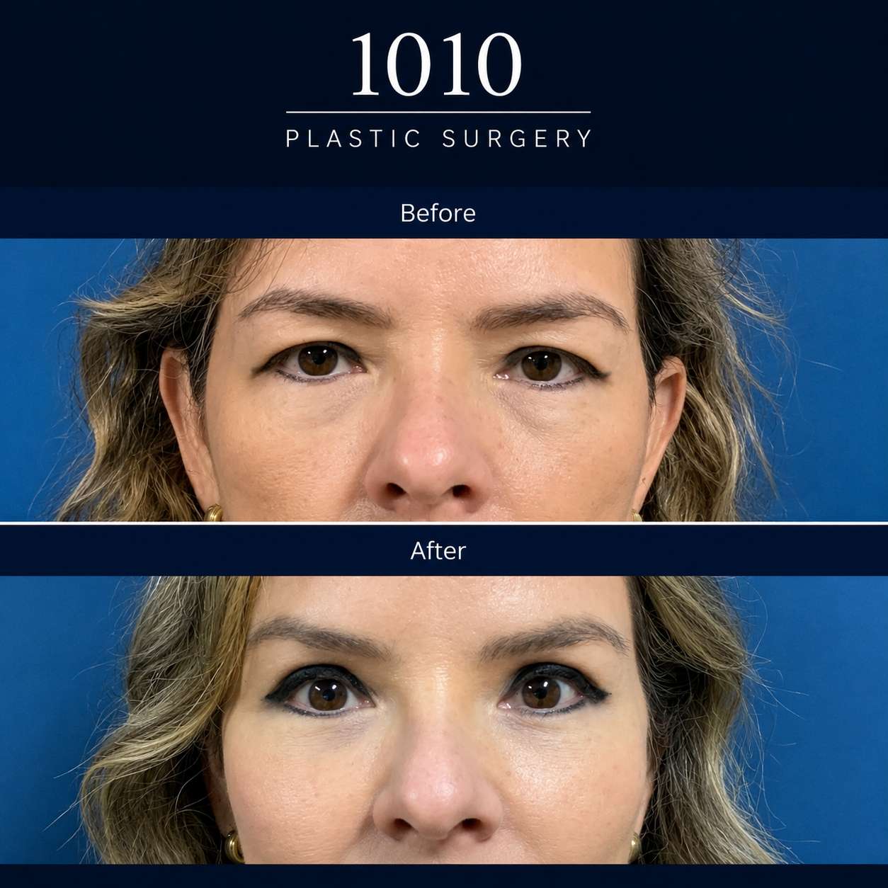 Chin liposuction before and after — 1010 Plastic Surgery