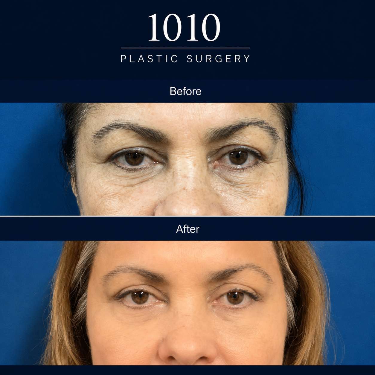 Chin liposuction before and after — 1010 Plastic Surgery