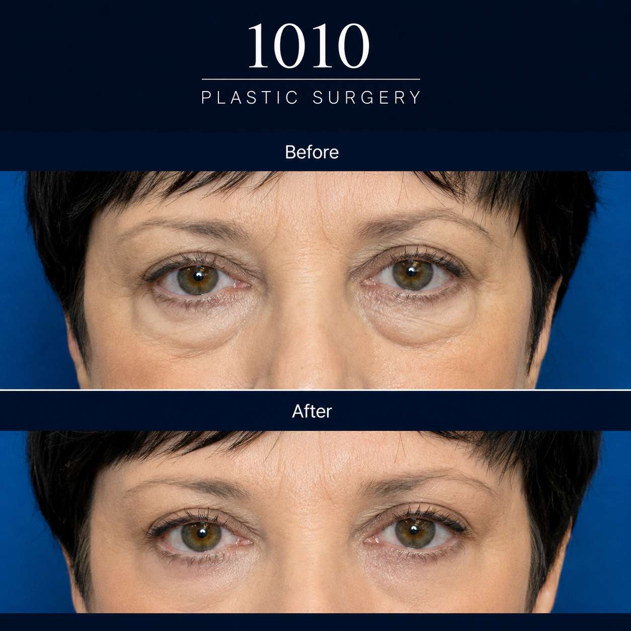 Chin liposuction before and after — 1010 Plastic Surgery