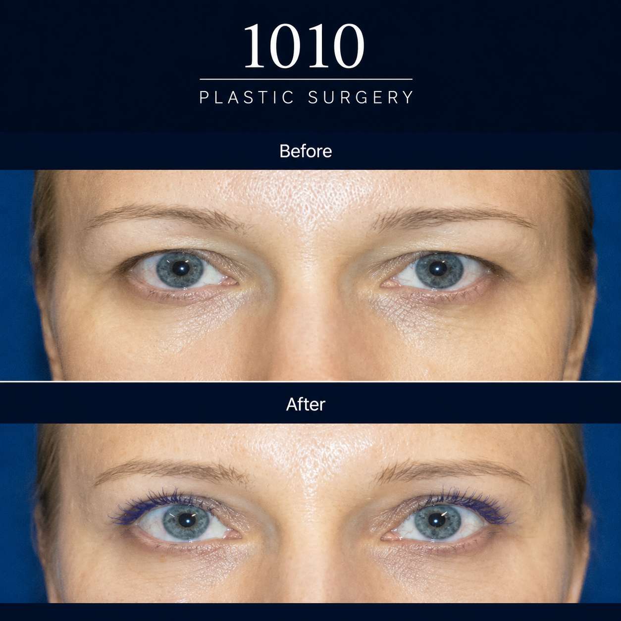 Chin liposuction before and after — 1010 Plastic Surgery
